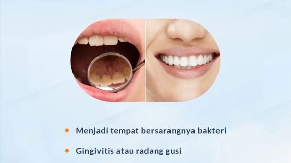 Bahaya Karang Gigi